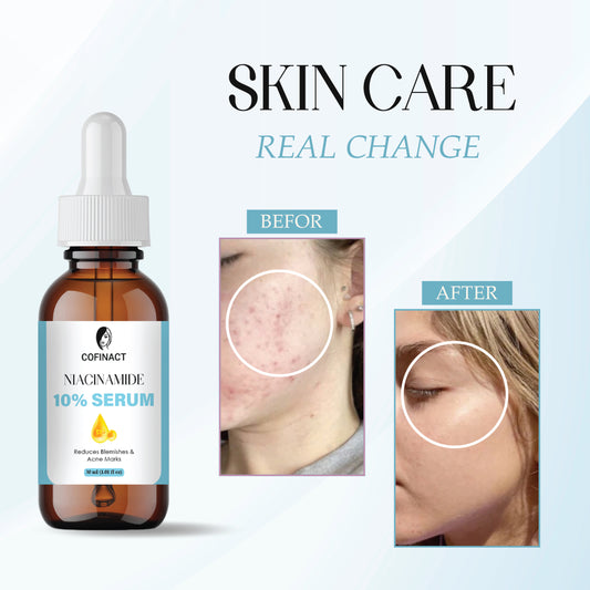 10% Niacinamide Serum for Face with Zinc – Oil Control, Pore Minimizer & Skin Brightening Serum for Clear, Even-Toned & Healthy Skin – Suitable for All Skin Types